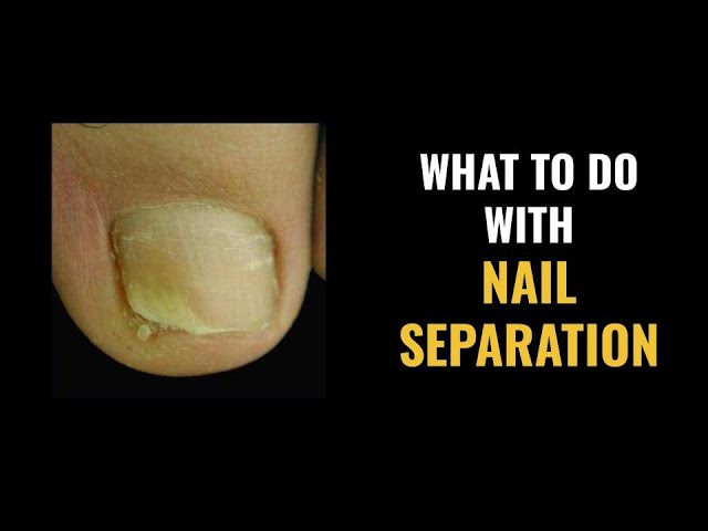 Onycholysis is when a nail (nail plate) on your fingers or toes separates  from the skin on which it rests (the nail bed). It is a common… | Instagram