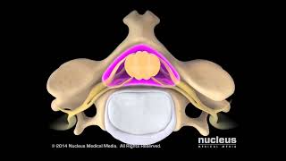 Laminectomía cervical posterior y fusión