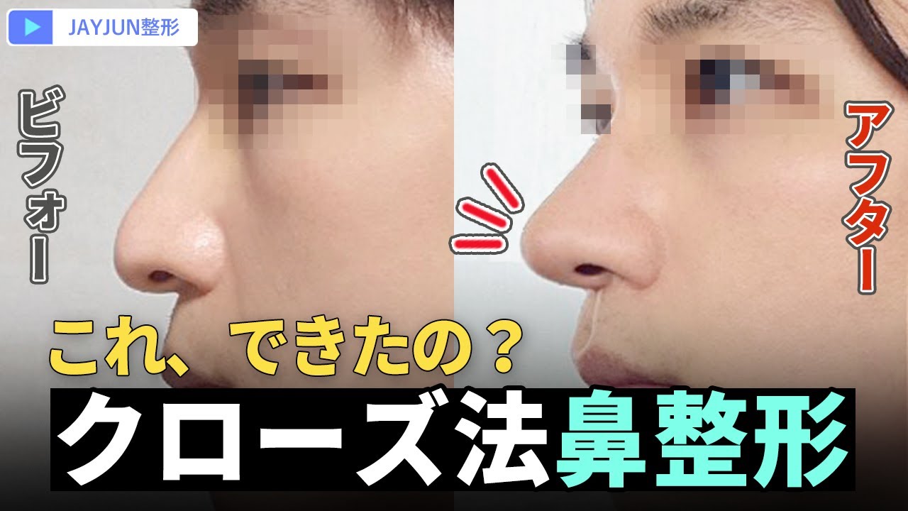 #鼻整形 #鼻手術 #クローズ法 #ジェイジュン整形外科皮膚科