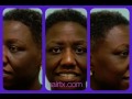 African-American Eyebrow and Hairline Video Transformation (Dallas, TX)