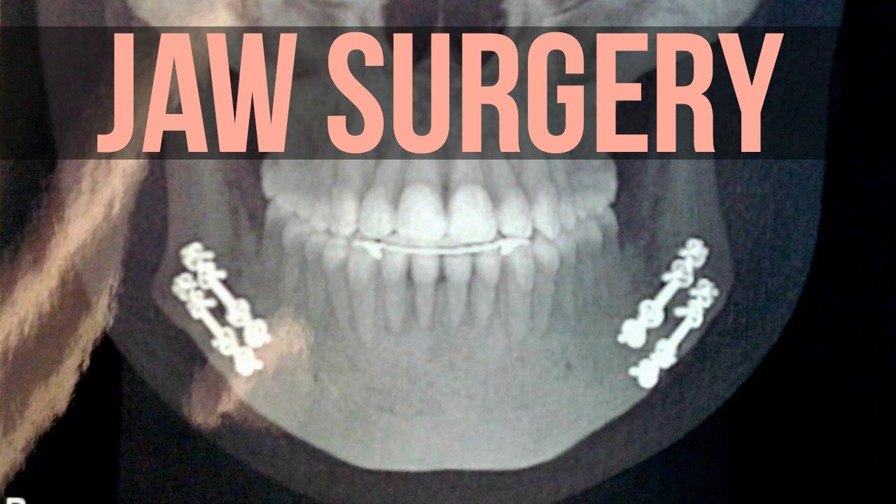 Jaw Surgery Part 1 YouTube