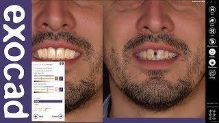 exocad Quick Guide: Learn Smile Creator in 7 min!