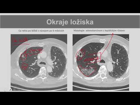 Video: Faryngotracheitida - Příčiny, Příznaky, Diagnostika, Léčebné Metody