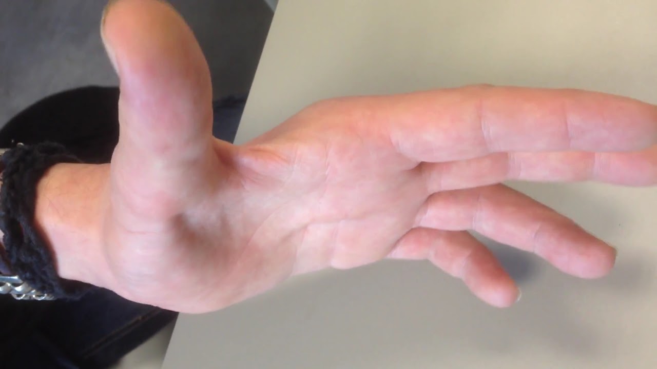 atrophie au niveau de la main sur compresion du nerf cubital au coude YouTube