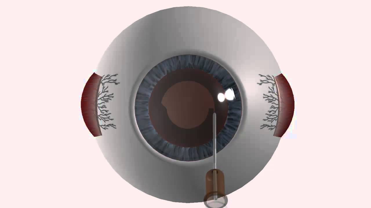 Cirurgia   Oftalmo 2 - All3 Soluções Inovadora