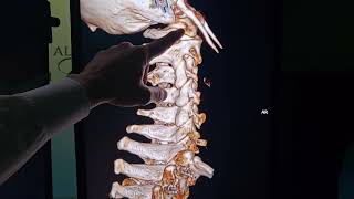 Elongated Styloid Processes Subluxating Atlas