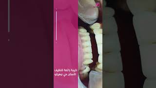 هل تريد التخلص من اصفرار الاسنان؟ toothcare toothcleaning cosmetics novello