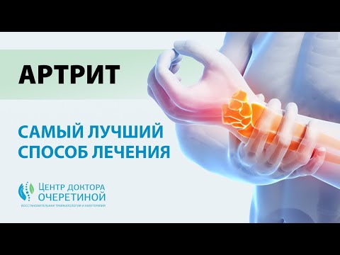 Артрит | ПРИЧИНЫ и эффективное ЛЕЧЕНИЕ артрита