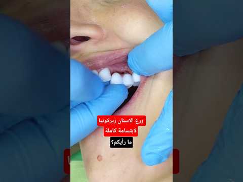 زرع الاسنان زيركونيا لابتسامة كاملة