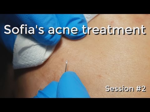 Sofia&#;s Acne Treatment: Session # - Part I