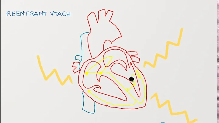 Ventricular Tachycardia - Types, Causes, and Treatment Approaches