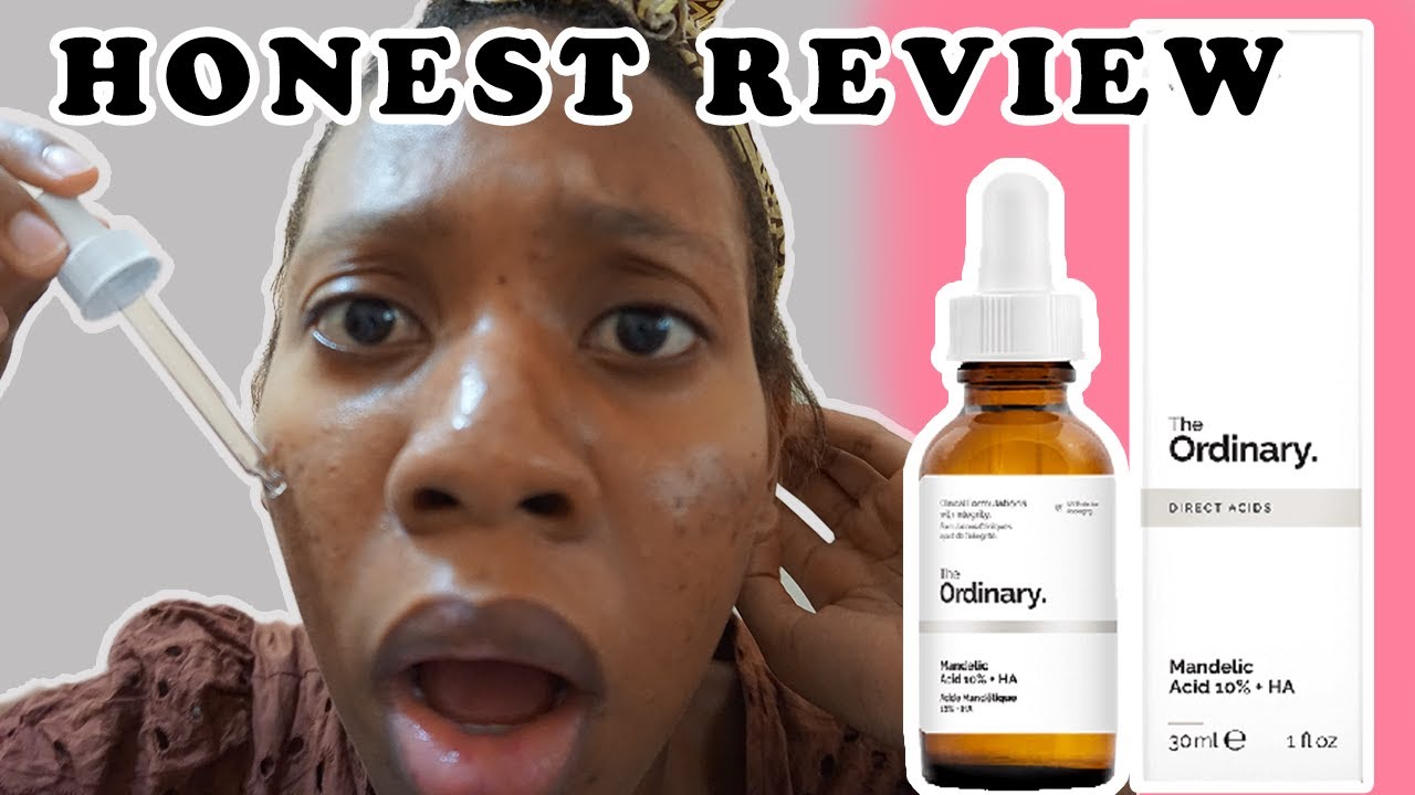 I TRIED THE ORDINARY MANDELIC ACID 10 FOR MY ACNE EVERYDAY FOR 2 WEEKS