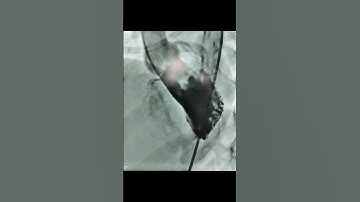 LV Angiogram showing VSD.