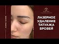 Лазерное удаление перманентного макияжа бровей