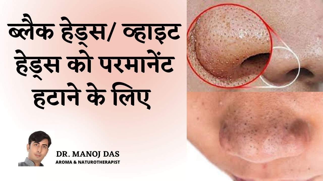 Blackheads जड़ से खत्म करने के लिए | HOME REMEDIES FOR BLACK AND WHITE HEADS I DR. MANOJ DAS