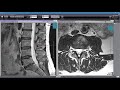 How to Read Your MRI with Onis 2.5 - part 2 of 2 (Advanced Lumbar Spine MRI Anatomy)