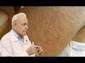 كانت تظن انه طفح جلدى على يديها ولم تكن تعرف انه أعراض مرض خطير 