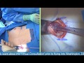 Breast Augmentation - Silicone: Live Streaming Plastic Surgery: Dr Michael  Brown