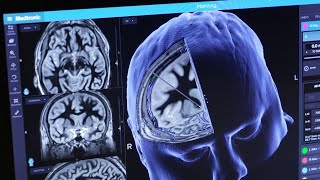 FDA clears blood test to help rule out Alzheimer’s disease in people showing symptoms
