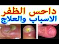 داحس الظفر التهاب حول الظفر الاسباب والعلاج 