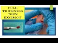 Video - full thickness corn excision (another case)