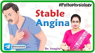 Angina Stabil: Penyebab, Patofisiologi, Gejala, Diagnosis dan Pengobatan ( Penyakit Dalam )