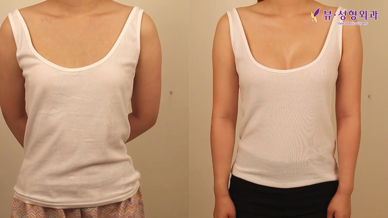 BEFORE AND AFTER BREAST AUGMENTATION SURGERY AT VIEW PLASTIC SURGERY