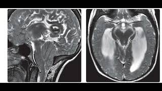 Congenital malformations brain imaging @ctisus @RadiologyChannel