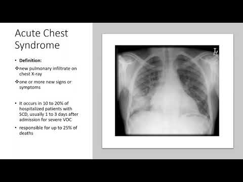 1/22/21 Pulmonary Complications of Sickle Cell Disease- Dr. Shakaroun