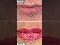 Hidratación de labios