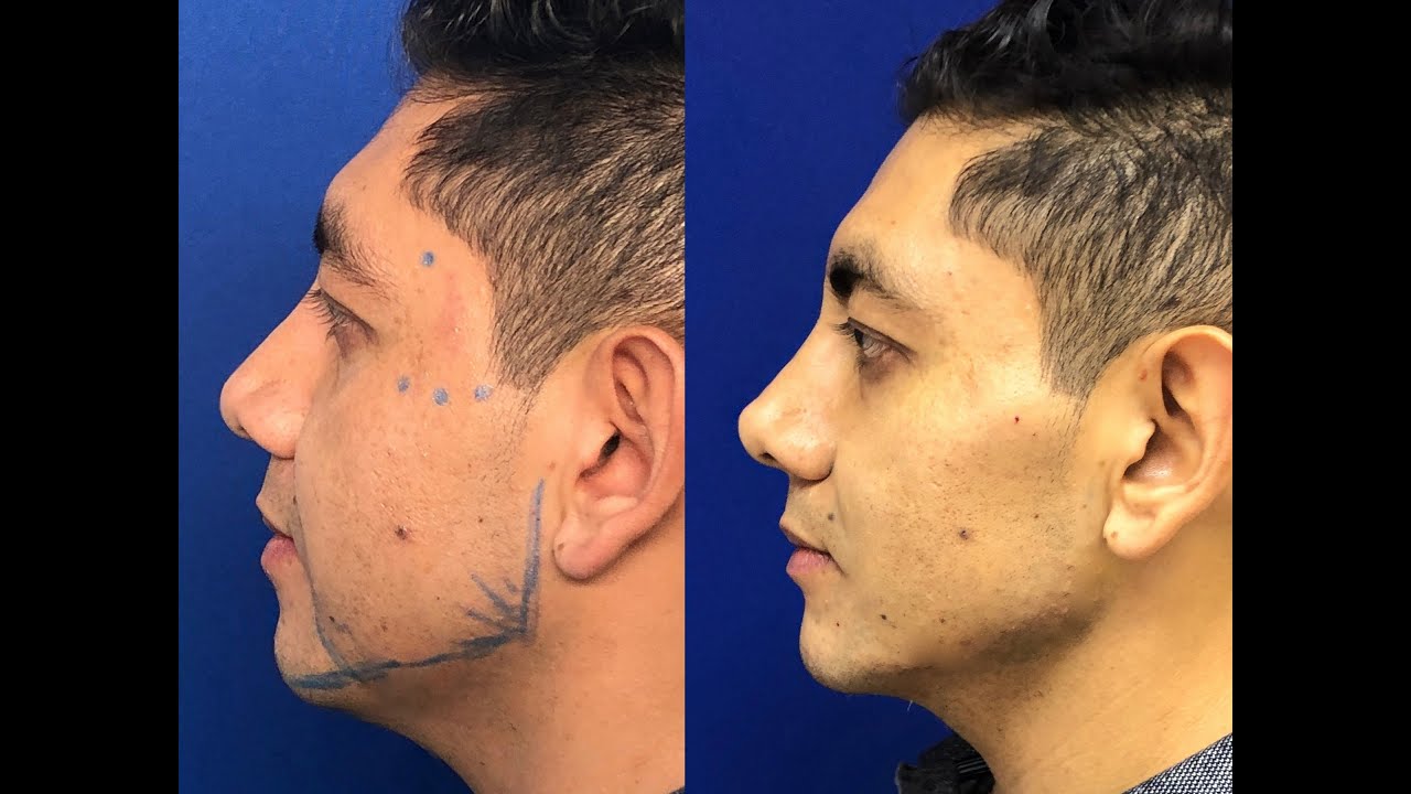 Perfilamiento y armonización facial - Dr. José Cortés