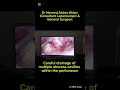 laparoscopic management of pelvic sepsis post normal vagunal delivery