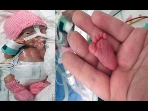 meet-the-world's-tiniest-baby-emilia-grabarczyk-,-was-born-weighing-just-229-grams