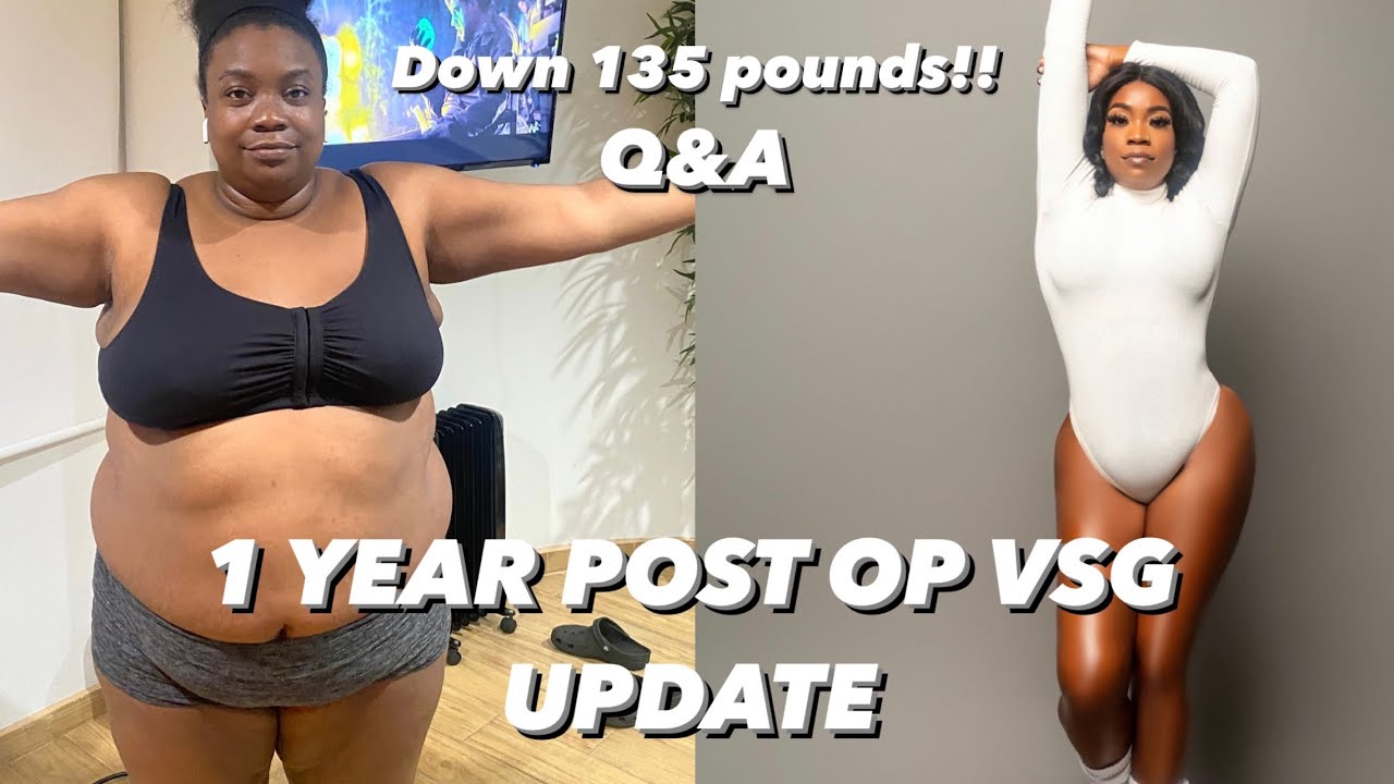 LIFE AFTER BARIATRIC SURGERY | 1 Year Post-Op Vertical Sleeve Gastrectomy Q&A