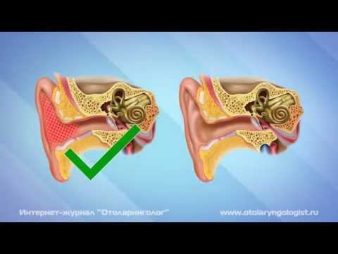 Серная пробка в ухе – симптомы, лечение