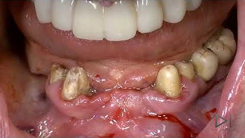 IMMEDIATE LOADING GUIDED SURGERY ATROPHIC MAXILLA dr.Giampiero Ciabattoni Digital Implantology Video
