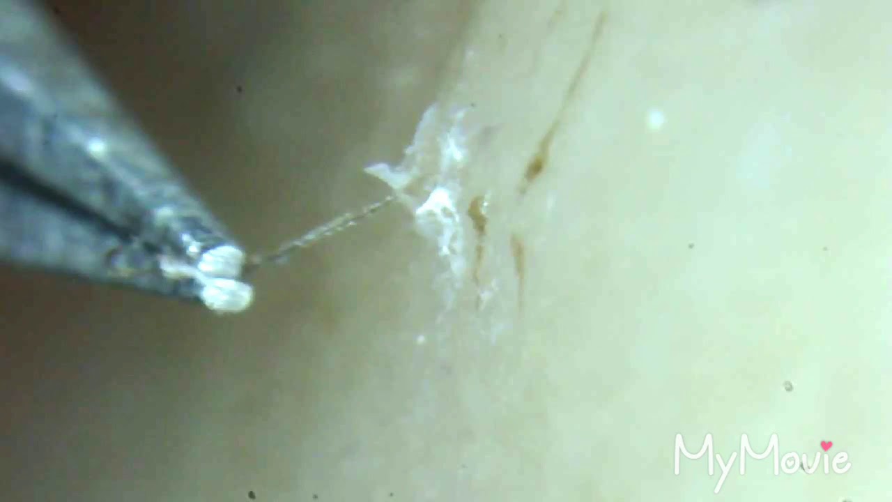 Exclusive Compilation Of Satisfying Plucking And Tweezing Ingrown