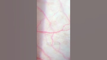 Red blood cells, on conjunctival blood vessels. Shot on iPhone 13pro. #ophthalmology #slitlamp