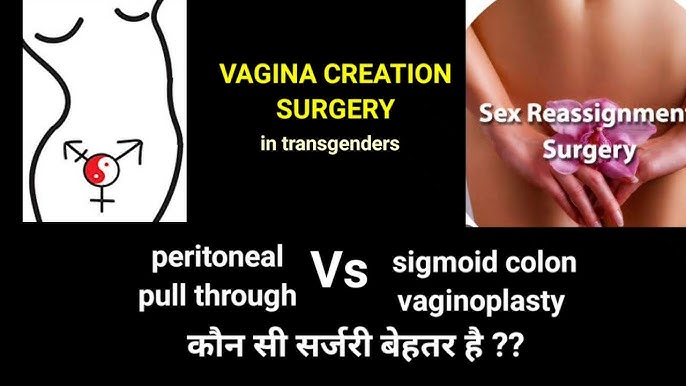 Transvestit vaginoplastikasidan oldin va keyin Transvestit vaginoplastikasidan oldin va keyin