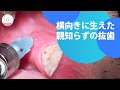 横向きに生えた左下親知らずの抜歯! Lower Wisdom Tooth Extraction