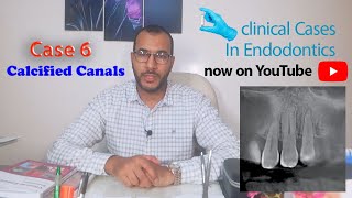 Clinical Cases in Endodontics part 6 (calcified canals & internal bleaching ) screenshot 1
