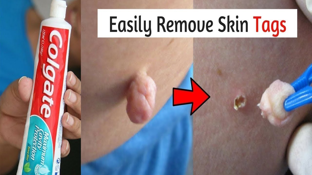 Removing Skin Tags