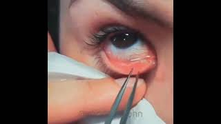 مقطع يوضح إزالة الدعامة من العين يتم هذا الإجراء عند انسداد القناة الدمعية