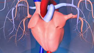 Implantable CardioverterDefibrillator (ICD)