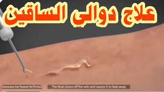 دوالي الساقين اسبابها وطرق علاجها