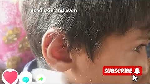 Ear Wax Removal _ Ear Wax Cleaning |  Parents Were Shocked ! Deep Relaxation Sounds