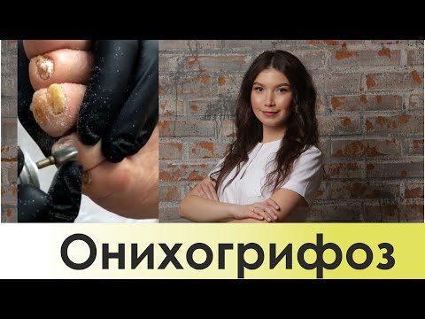 Аппаратный педикюр, утолщенный ноготь. Онихогрифоз. Трансляция из Instagram