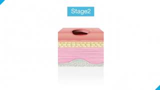 Stages Of Bedsores: Understanding Stages 1, 2, 3, & 4