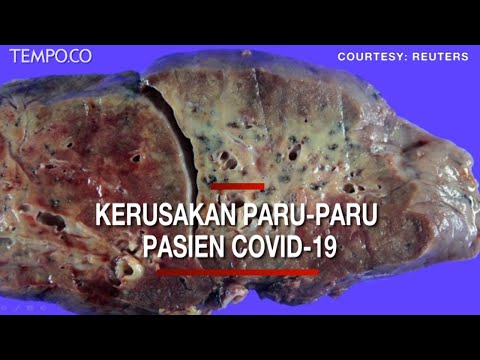 Video: Dokter Pskov Menyelamatkan Pasien Dengan Kerusakan Paru-paru 90%