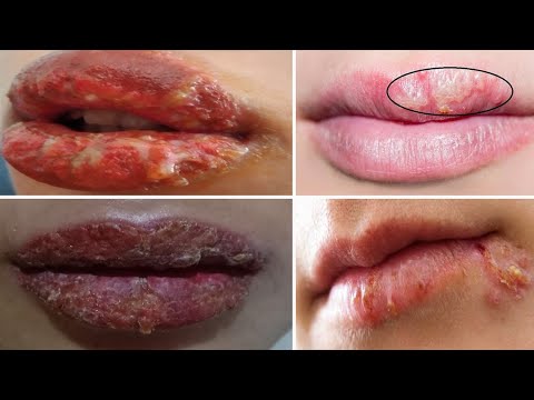 Hướng Dẫn Phân Biệt & Xử Lý Môi Bị Nhiễm Trùng Với Môi Bị Mụn Nước Herpes